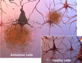 Wizualna ilustracja hipotezy - odkładające się złogi amyloidu blokujące synapsy i neurony (po prawej - zdrowe)
