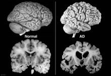 Zdjęcie rentgenowskie mózgu zdrowego i chorego