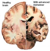 Zmiany w mózgu spowodowane chorobą Alzheimera - źródło: www.alz.org
